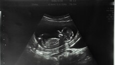 В Британии зафиксировали рекордное число абортов за всю историю наблюдений